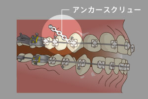 矯正用アンカースクリュー