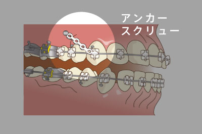 歯科矯正用アンカースクリュー